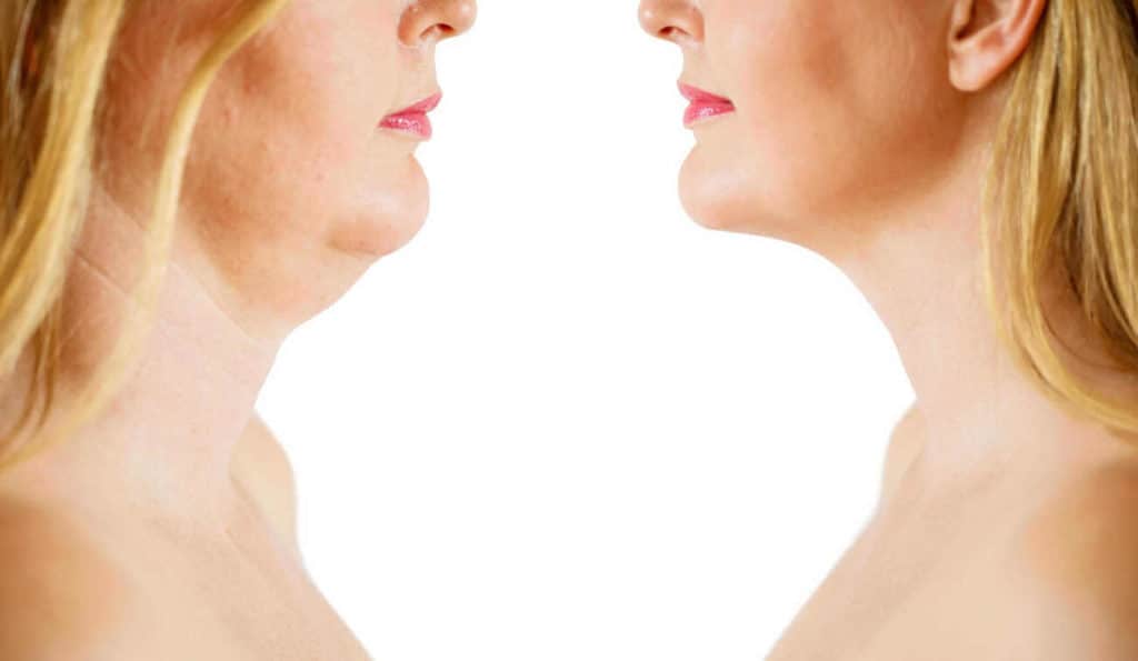Double Chin treatment Arundel before and after results