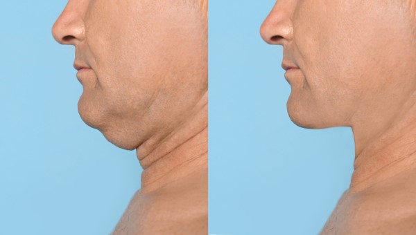 Which Non-Surgical Treatments Work Best for Jowls and Loose Skin Arundel?