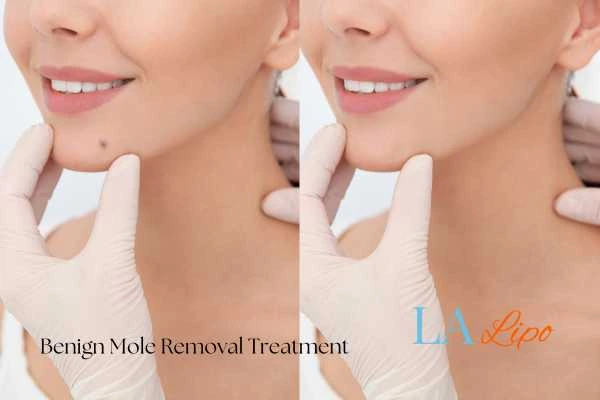 woman's before and after mole removal Arundel results