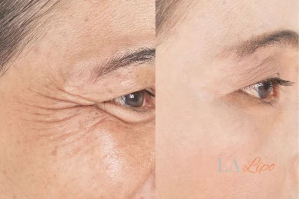 Before and after results of woman - HI-fu wrinkles reduction treatment Arundel