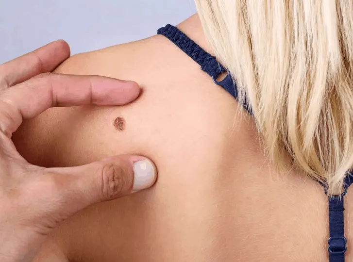 woman having mole removal Arundel consultation before treatment.