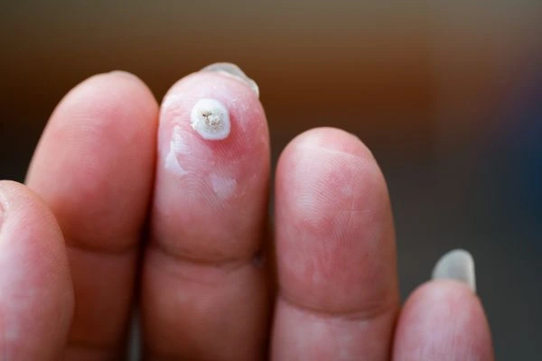wart on person finger - cryotherapy to treat from LA LIPO Arundel
