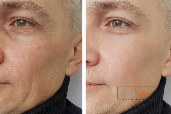 See the amazing results of Morpheus8 Treatment Arundel!