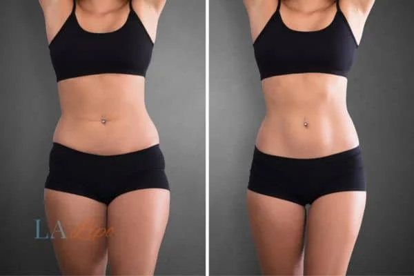 before and after results of non-surgical treatment to help a woman's body image and mental health Arundel