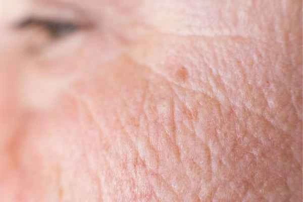 close up picture of a woman's face showing an age spot Arundel