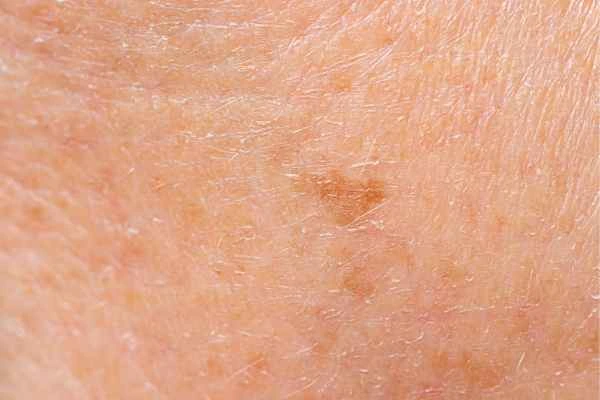 close up picture of age spots Arundel