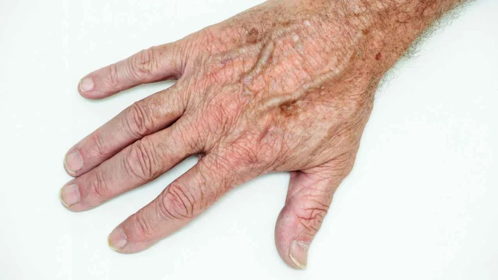 Male hand showing age spot Arundel