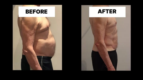 What Symptoms Can Diastasis Recti Cause in Men? Weak Core, Back Pain and Poor Posture Arundel